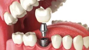 dental-implants-allen-texas